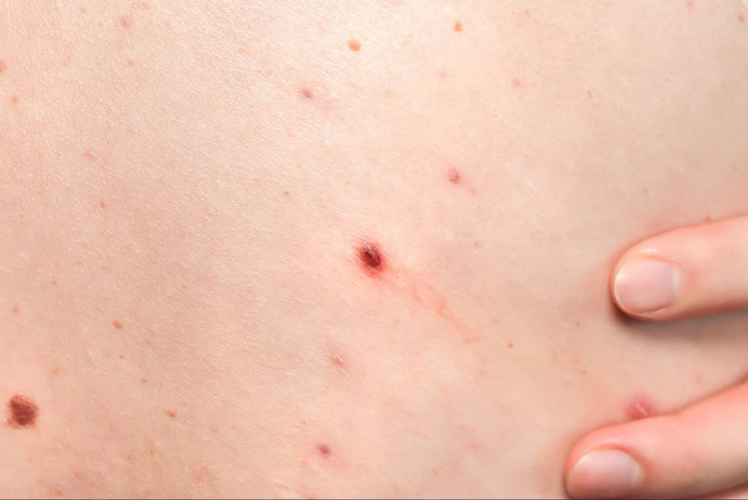 Close-up of skin showing multiple moles and small pigmented lesions on the back